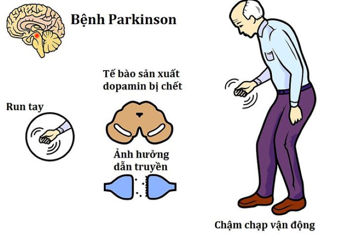 Nguyên nhân Parkinson